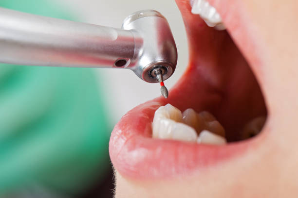 Best Emergency Root Canal Treatment in Boulder City, NV